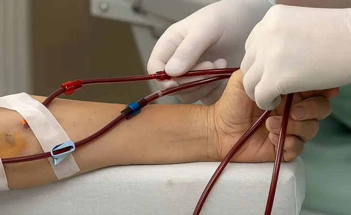 Arteriovenous fistula
