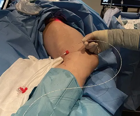 EVLA (Endovenous Laser Ablation) for Varicose Veins