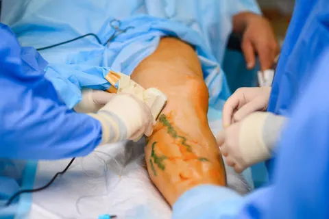 Ultrasound Guided Foam Sclerotherapy for Varicose Veins