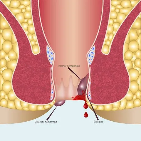 Haemorrhoids Treatment