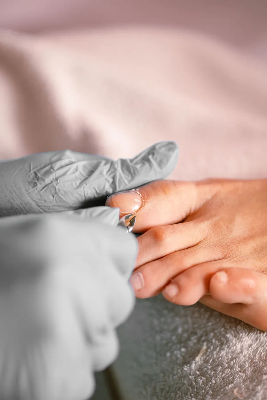 Treatment for an ingrown toenail