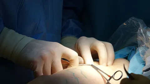 Surgery for Varicose Veins